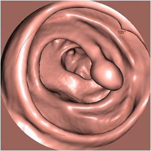 大腸CTイメージ
